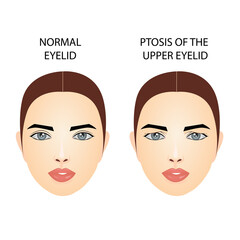 Ptosis of the upper eyelid, medical vector illustration