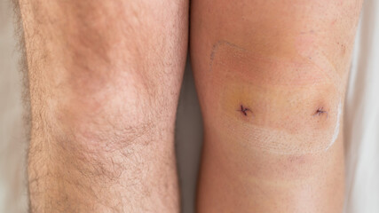Close-up of a surgical suture on the knee after laparoscopic minisk surgery. Male legs after surgery