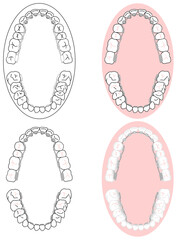 正しい歯並びに矯正治療の裏側矯正のメタルブラケット装着セット