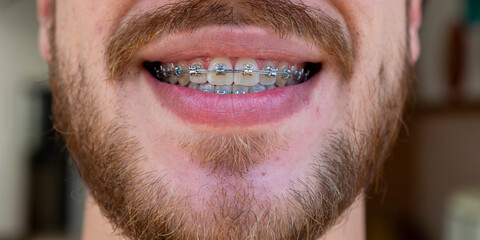 face of man with mustache and beard wearing orthodontic appliance