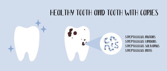 Healthy tooth and tooth with caries. Plaque bacteria: Streptococcus mutans, Streptococcus viridans. Oral care. Dental cavity, teeth hygiene. Vector flat cartoon illustration