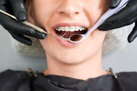Top view on girl's mouth in dentist chair. Cropped dentist's hands, in black rubber gloves, checking up braces on patient's teeth with steel dental tools. Ceramic and metal brackets. Macro photography