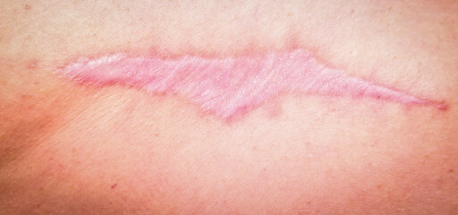 Hypertrophic scars (cicatrix) on the back, muscle tissue transplant, Collagen synthesis. Close-up....