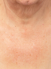 Fototapeta premium pigmentation on the skin in the neck and chest area as a background