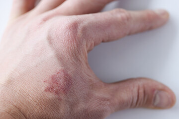 Fototapeta premium On skin of hand there is red spot and peeling