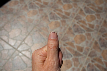 splitting nail with blood clotting