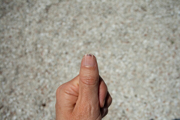 splitting nail with blood clotting