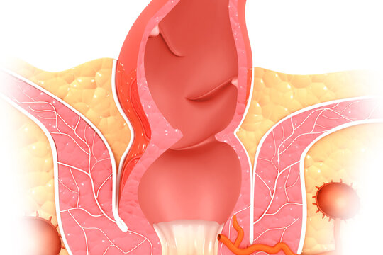 Haemorrhoids (piles) on scientific background. 3d illustration