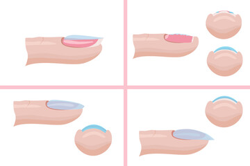 Hand nail care. The technique of applying the base layer of manicure, mistakes. Illustration for the manicure guide. Vector illustration