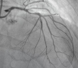 Coronary angiogram , medical x-ray for heart disease. Coronary artery disease.	