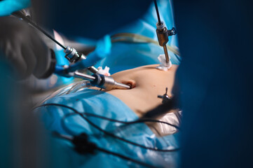 Endoscopic surgery to remove the uterus - 414682371