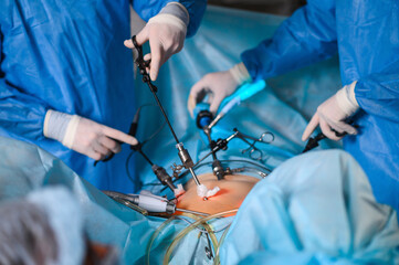 Endoscopic surgery to remove the uterus