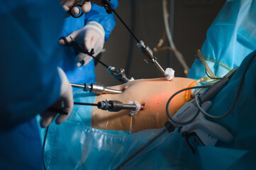 Endoscopic surgery to remove the uterus - 414682995