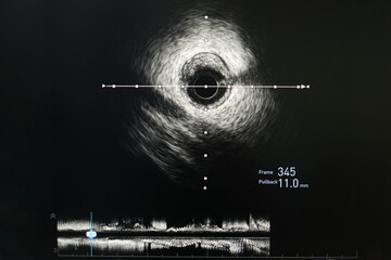 Intravascular ultrasound imaging (IVUS) at cardiac catheterization laboratory room.