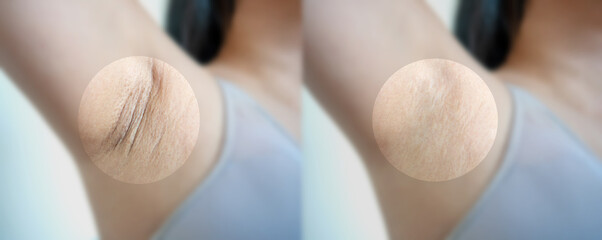 Asian woman with underarm chicken skin problem, Fox Fordyce, black armpit in woman. before and after skincare cosmetology armpits epilation treatment concept.  - obrazy, fototapety, plakaty