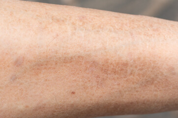 peeling skin on the arm as a background