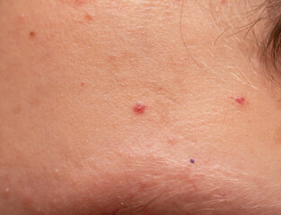 Fototapeta premium red allergic rash on the skin of the face