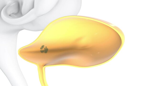 Cystitis, urinary tract infection, inflammation of the bladder. The bacteria enters the bladder via the urethra and multiplies. 3D animation on white background