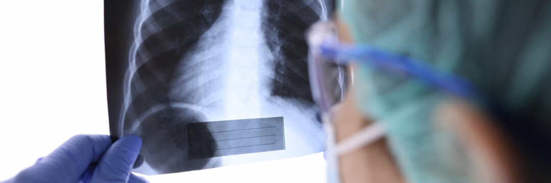 Pulmonologist In Goggles And Mask Looks At X-ray Of Lungs In Clinic. X Ray Diagnostics Of Lung Diseases During Epidemic Of Coronavirus Infection Concept.