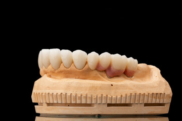 Close-up side view of a dental upper jaw prosthesis on black glass background. Artificial jaw with veneers and crowns. Tooth recovery with implant. Dentistry conceptual photo. Prosthetic dentistry.
