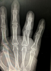 X-ray image of the palm of the broken ring finger