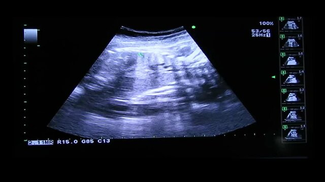 Diaphragm of human embryo on an ultrasound display