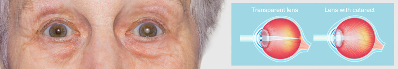 Cataract concept. Senior woman's eye, closeup