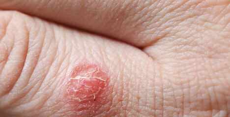 Atopic dermatitis (AD), also known as atopic eczema, is a type of skin inflammation (dermatitis) on the fingers.