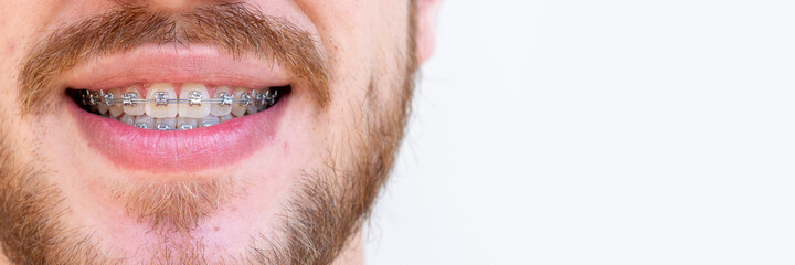 detail of man face using orthodontic appliance for teeth correction. Space for text.