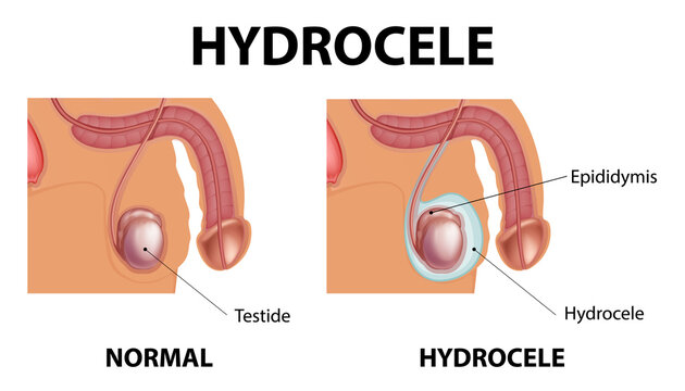 Human hydrocele symptoms diagram