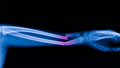 Blur photo for background.Radiograph on dark background.The film use for diagnosis the illness of patient.Medical concept. Fracture both bone forearm in children with plastic deformity.Green stick.