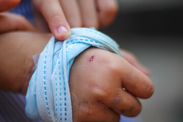 Little girl  hand with old wounds from  dog bite on background