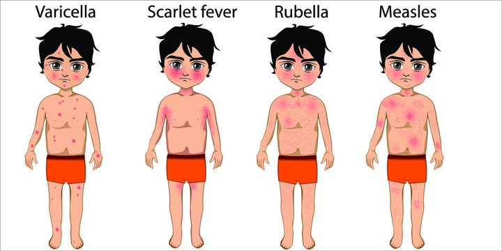 Scarlet fever mouth with symptoms of scarlatina Vector Image