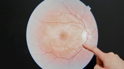 Female eye doctor optician optometrist shows client patient damages in eyes blood vessels at health care check up need prescription for glasses surgical medical eye laser pupils blind blindness old