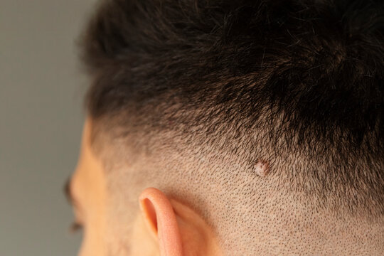 Medical examination of the danger of the patient's moles.