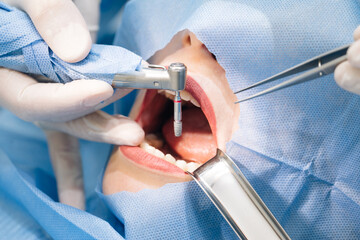 Close-up shot of attentive doctors performing surgical operation installing dental implants into...