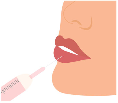 Filler injection concept. Serum syringe injects filler to lip of woman vector illustration. Plastic, aesthetic cosmetology beauty treatment concept