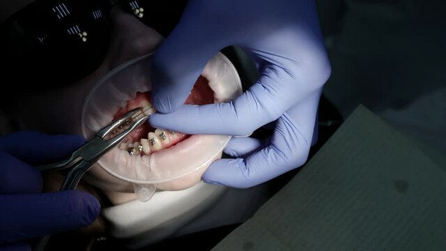 Close-up of a patient with a mouth dilator in a dental office, a doctor in gloves removes braces, various procedures are performed with the help of dental instruments.