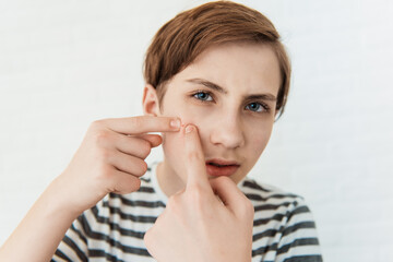 Teen boy with red pimple on on his face, closeup. Acne and skin problem