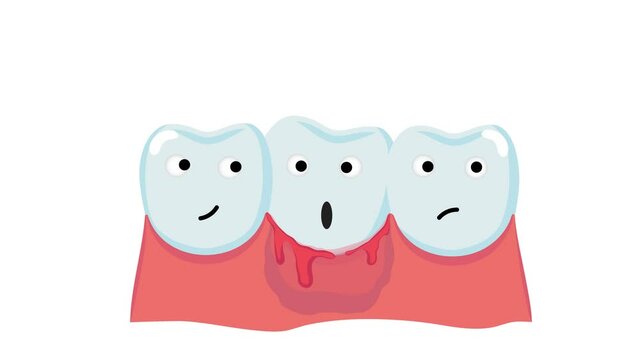 Flat vector animation for dentistry.
The teeth of the characters show their emotions, one got sick, his gums are bleeding, he is in a panic, if not treated, this leads to periodontal disease.