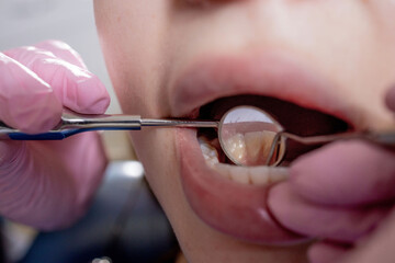 Dentist examining patient teeth with a mouth mirror and dental excavator. Close-up view on the woman