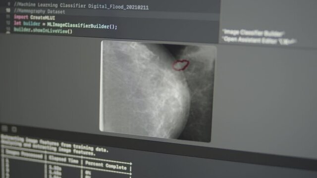 2.42 Real Neural Network Machine Learning Analyzes X-ray Mammography Screening Images Mammogram Detection Breast Cancer