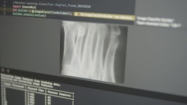 2.36 Real Neural Network Machine Learning Analyzes X-ray Bones Detecting Osteoporosis Сalcium Deficiency and Anorexia Fragility
