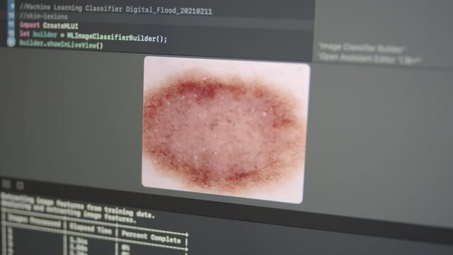 2.24 Real Neural Network Machine Learning Analyzes Skin Lesion Melanoma Cancer Detection
