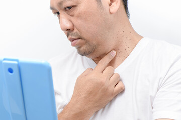 Middle-aged mam point to Skin Tags or Acrochordon on neck man