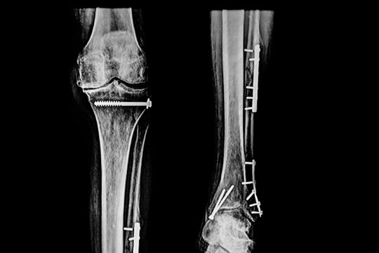X- Ray image of the distal third of femur and proximal of the tibia with screws  after surgery due to fracture. Medical themes.