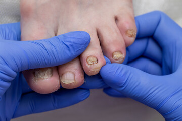 A podiatrist examines a sore foot with destroyed nails. Toenail fungus. Medical pedicure in the salon.