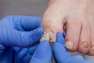 The podiatrist cuts off the damaged part of the diseased nail. 