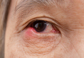 Eye stye infection women aisa
