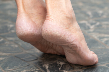 dry cracked skin on the heels of the feet